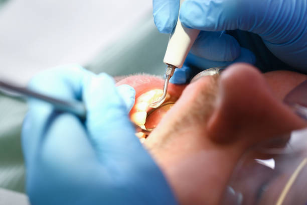 Best Emergency Wisdom Teeth Removal in Hudson, CO