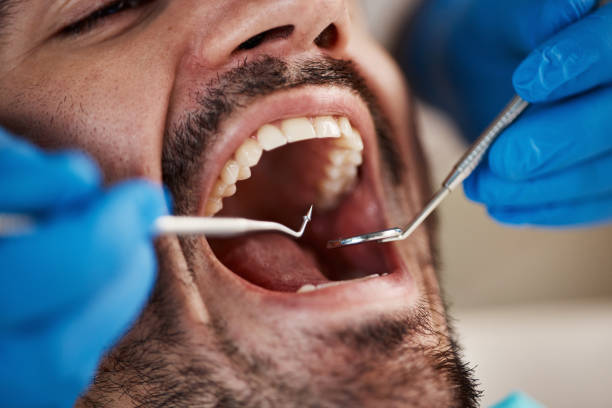 Best Emergency Treatment for Dental Infections or Abscesses in Hudson, CO